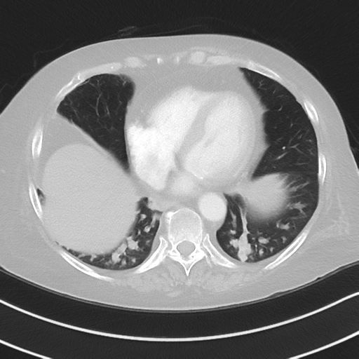 Aspiration bronchiolitis (Radiopaedia 53464-59463 Axial lung window 41).png