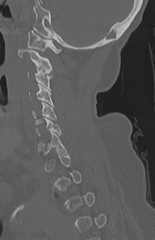 Atlanto-axial subluxation (Radiopaedia 36610-38176 Sagittal bone window 31).png