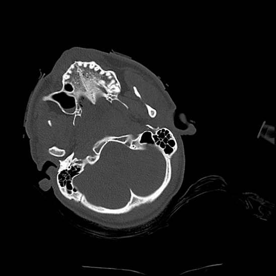 Atlanto-occipital dissociation (Traynelis type 1), C2 teardrop fracture, C6-7 facet joint dislocation (Radiopaedia 87655-104061 Axial bone window 9).jpg