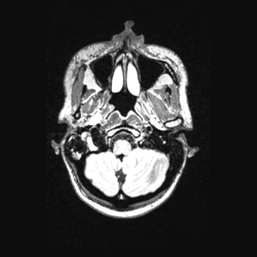 Atretic encephalocoele with inferior vermis hypoplasia (Radiopaedia 30443-31108 Axial 29).jpg