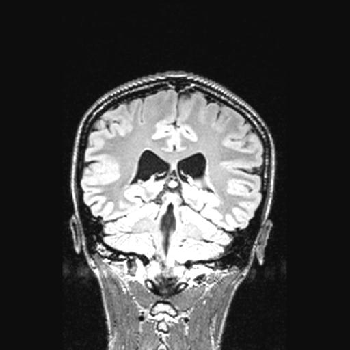 File:Atretic encephalocoele with inferior vermis hypoplasia (Radiopaedia 30443-31108 Coronal FLAIR 72).jpg