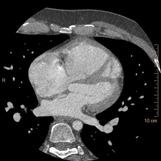 Atrial septal defect (upper sinus venosus type) with partial anomalous pulmonary venous return into superior vena cava (Radiopaedia 73228-83961 A 137).jpg