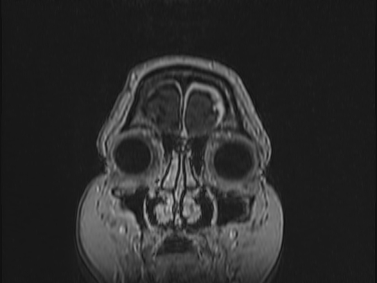 File:Atypical meningioma (Radiopaedia 62985-71406 Coronal T1 C+ 4).jpg