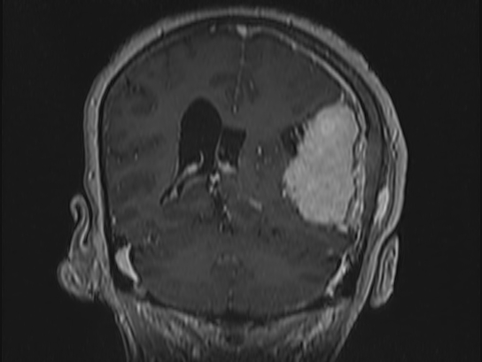 Atypical meningioma (Radiopaedia 62985-71406 Coronal T1 C+ 82).jpg