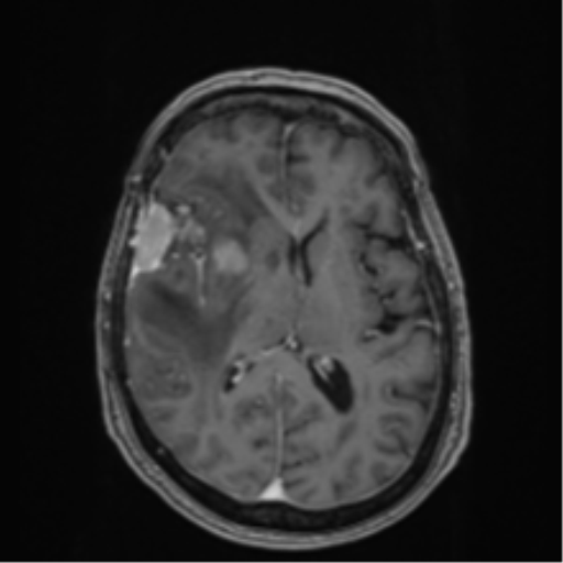 Atypical meningioma (WHO Grade II) (Radiopaedia 54742-60979 Axial T1 C+ 35).png