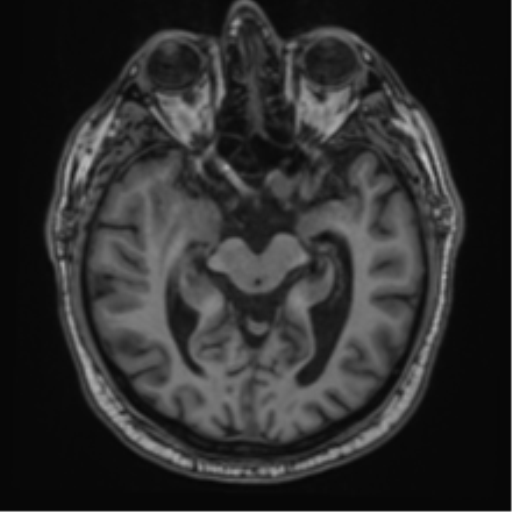 File:Atypical meningioma (WHO grade II) with brain invasion (Radiopaedia 57767-64729 Axial T1 20).png