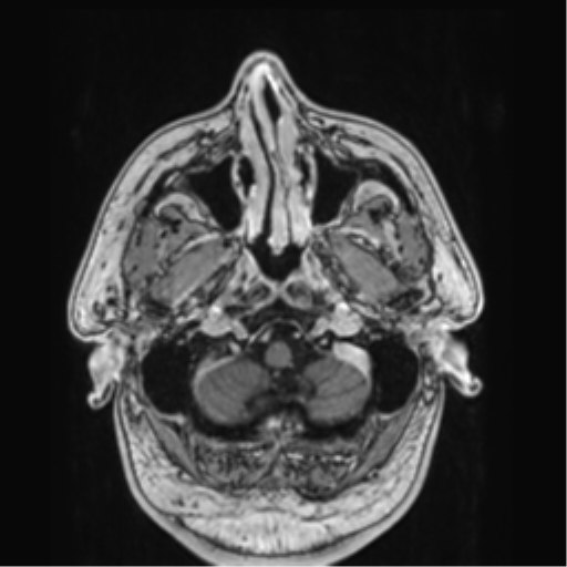 File:Atypical meningioma (WHO grade II) with brain invasion (Radiopaedia 57767-64729 Axial T1 C+ 4).png