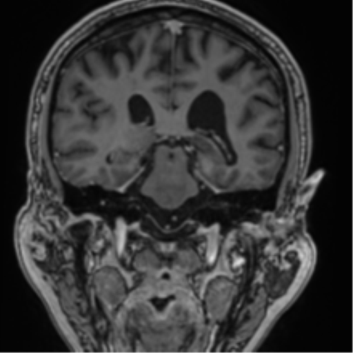 Atypical meningioma (WHO grade II) with brain invasion (Radiopaedia 57767-64729 Coronal T1 C+ 50).png