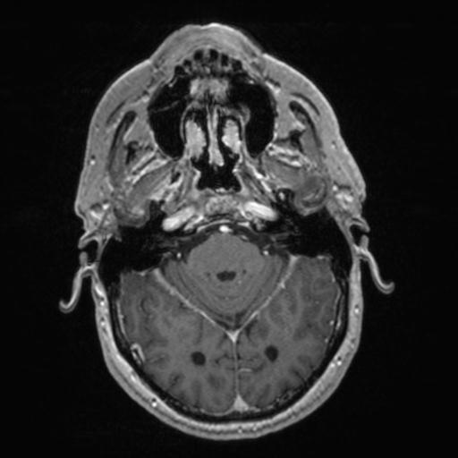 Atypical meningioma (grade II) - en plaque (Radiopaedia 29633-30147 Axial T1 C+ 59).jpg