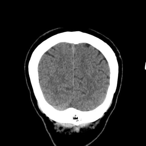 Atypical meningioma with skull invasion (Radiopaedia 34357-35649 Coronal non-contrast 55).png