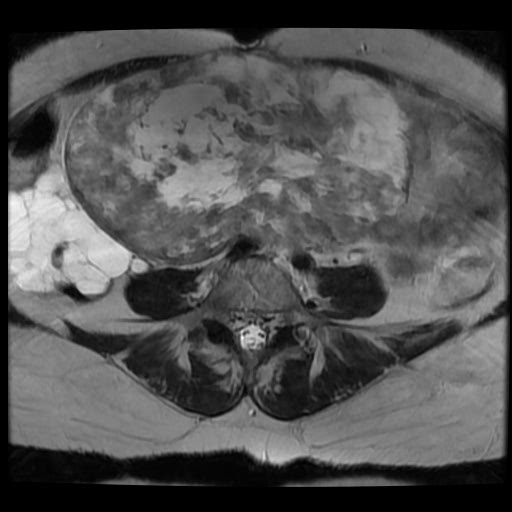 File:Atypical retroperitoneal lymphocoeles with large leiomyoma of uterus (Radiopaedia 32084-33027 Axial T2 8).jpg