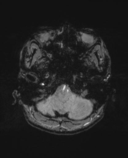 File:Autoimmune limbic encephalitis (Radiopaedia 30363-31005 SWI - magnitude 11).jpg