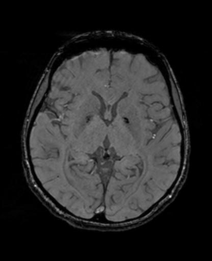 Autoimmune limbic encephalitis (Radiopaedia 30363-31005 SWI - magnitude 39).jpg