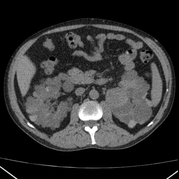 File:Autosomal dominant polycystic kidney disease (Radiopaedia 36539-38101 Axial non-contrast 36).jpg