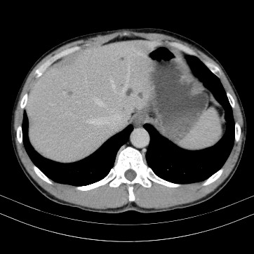 Autosomal dominant polycystic kidney disease (Radiopaedia 66349-75582 B 12).jpg