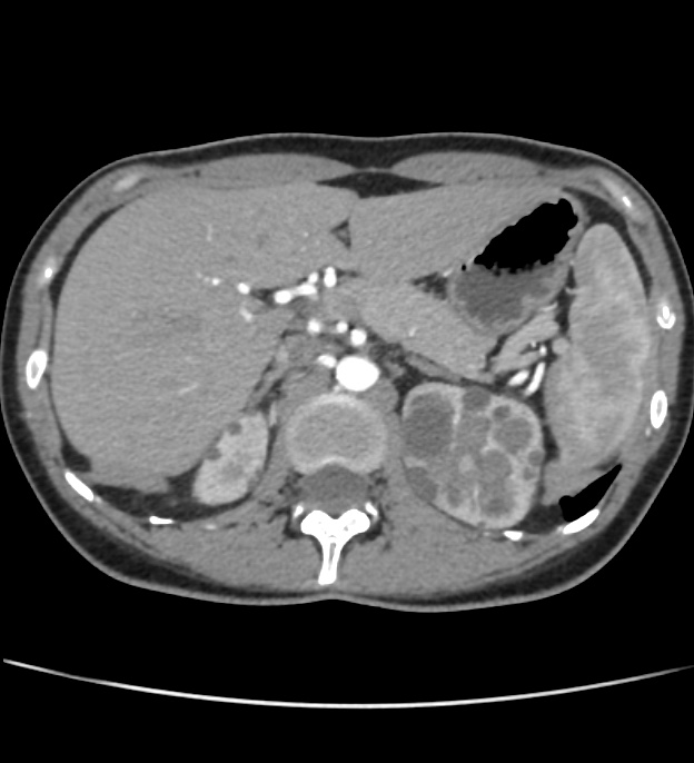 Autosomal dominant polycystic kidney disease - early onset (Radiopaedia 40734-43387 B 8).jpg