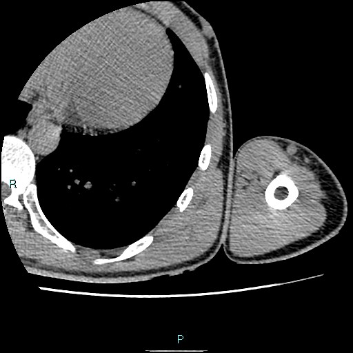 File:Avascular necrosis after fracture dislocations of the proximal humerus (Radiopaedia 88078-104653 D 104).jpg