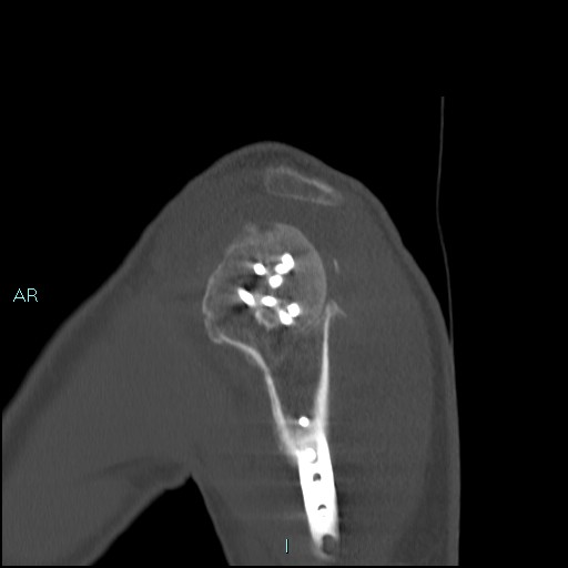 Avascular necrosis after fracture dislocations of the proximal humerus (Radiopaedia 88078-104653 Sagittal bone window 21).jpg