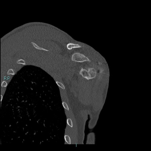 Avascular necrosis after fracture dislocations of the proximal humerus (Radiopaedia 88078-104655 Coronal bone window 105).jpg