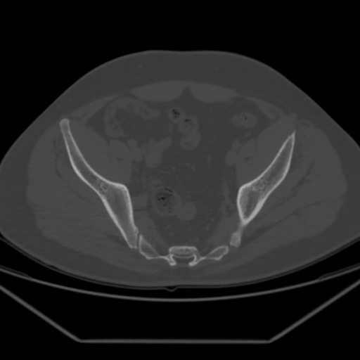File:Avascular necrosis of the hip (Radiopaedia 61503-69467 Axial bone window 18).jpg