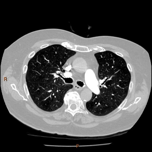 Azygos lobe (Radiopaedia 40161-42821 Axial lung window 27).jpg