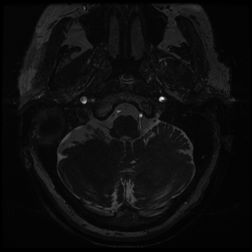 File:Balo concentric sclerosis (Radiopaedia 53875-59982 Axial T2 FIESTA 8).jpg
