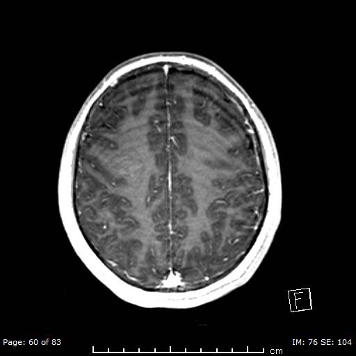 Balo concentric sclerosis (Radiopaedia 61637-69636 Axial T1 C+ 60).jpg
