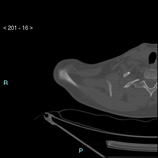 Bankart lesion with glenoid bone defect - assessment TC with PICO method (Radiopaedia 42855-93901 Axial bone window 15).jpg