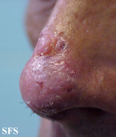 Basal Cell Carcinoma (Dermatology Atlas 60).jpg
