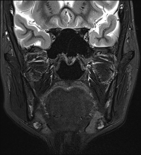 File:Basal cell carcinoma - nasal region (Radiopaedia 70292-80365 Coronal STIR 20).jpg