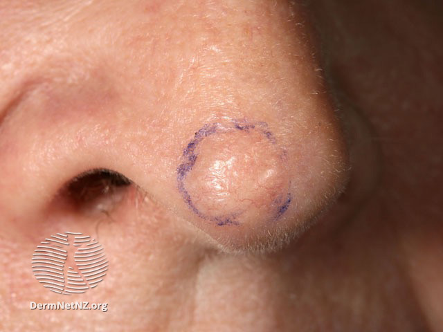 File:Basal cell carcinoma affecting the nose (DermNet NZ lesions-bcc-nose-0655).jpg