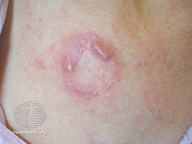 File:Basal cell carcinoma affecting the trunk (DermNet NZ lesions-bcc-trunk-1243).jpg