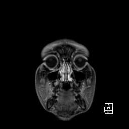 File:Base of skull rhabdomyosarcoma (Radiopaedia 32196-33142 I 15).jpg