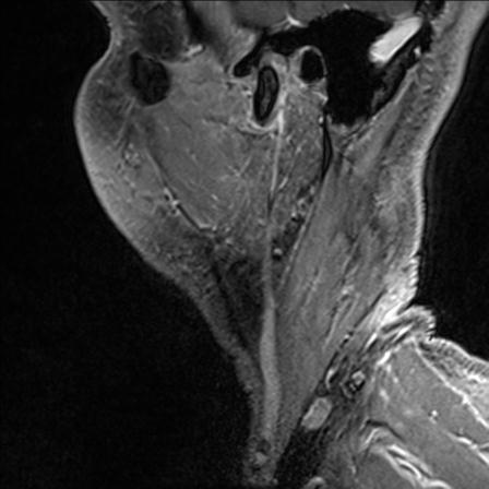 Base of tongue squamous cell carcinoma (Radiopaedia 31174-31884 F 158).jpg
