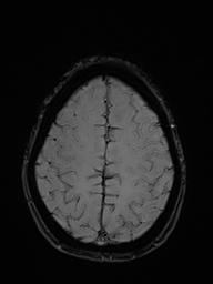 File:Basilar artery perforator aneurysm (Radiopaedia 82455-97733 Axial SWI 49).jpg