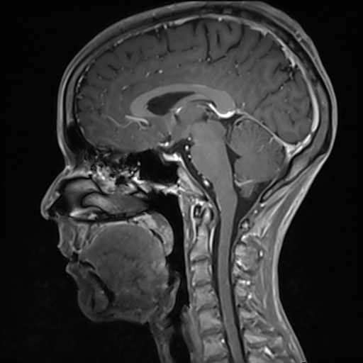 Basilar artery perforator aneurysm (Radiopaedia 82455-97733 G 78).jpg
