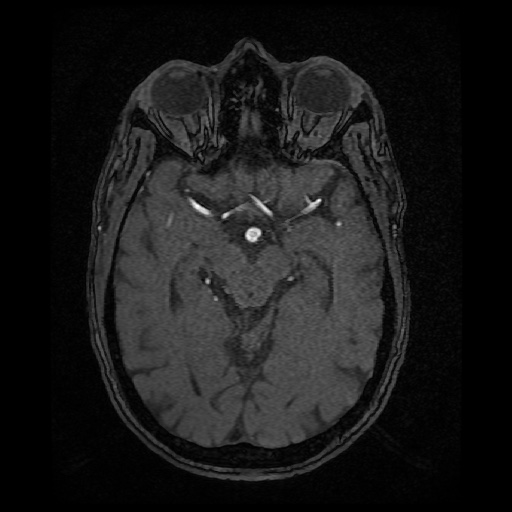 Basilar top and left middle cerebral artery aneurysm (Radiopaedia 61965-70031 Axial MRA 66).jpg