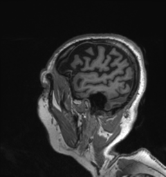Behavioral variant frontotemporal dementia and late onset schizophrenia (Radiopaedia 52197-58083 Sagittal T1 1).png