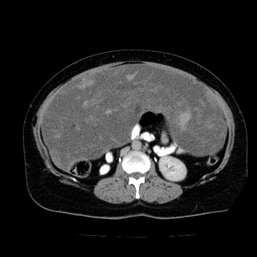 File:Benign spindle cell tumor - abdominopelvic (Radiopaedia 61300-69212 Axial C+ delayed 30).jpg