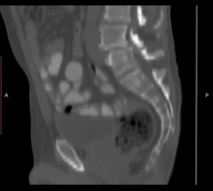 Bertolotti syndrome (Radiopaedia 58974-66235 Sagittal bone window 23).jpg