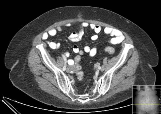 Bicameral celiacomesenteric aneurysm (Radiopaedia 55766-62327 A 54).jpg