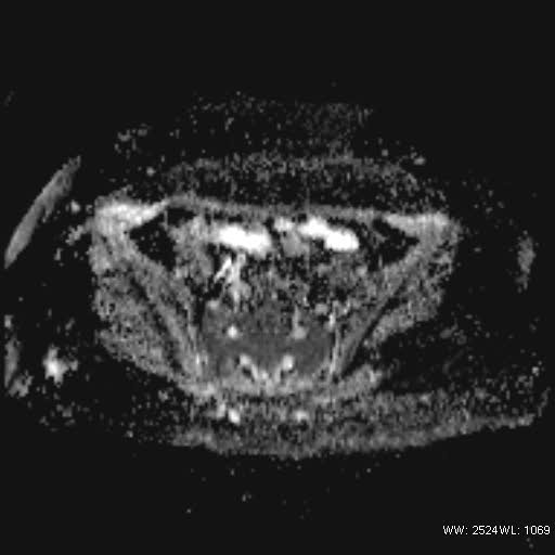 File:Bicornuate uterus- on MRI (Radiopaedia 49206-54297 Axial ADC 8).jpg