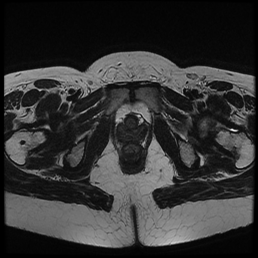 File:Bicornuate uterus (Radiopaedia 51676-57472 Axial T2 9).jpg