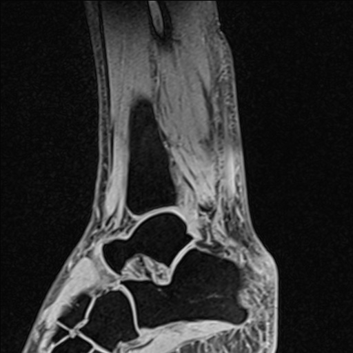 Bilateral Achilles tendon complete tear (Radiopaedia 81344-95051 Sagittal WE - Left 75).jpg
