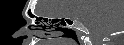 Bilateral Ectopic Infraorbital Nerves (Radiopaedia 49006-54084 Sagittal bone window 24).jpg