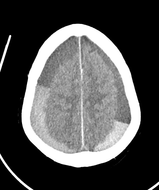 Bilateral acute on chronic subdural hematomas (Radiopaedia 78466-91146 Axial non-contrast 43).jpg
