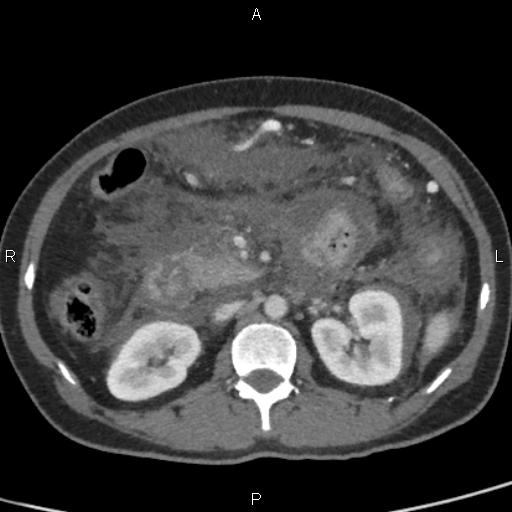 Bilateral adrenal gland hyperenhancement in pancreatitis (Radiopaedia 86642-102753 E 46).jpg