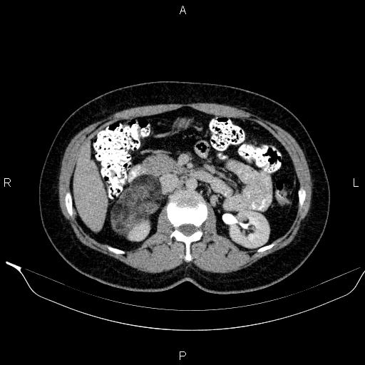 Bilateral adrenal myelolipoma (Radiopaedia 63058-71535 Axial C+ delayed 48).jpg