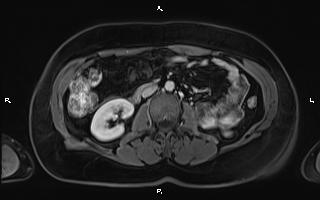 Bilateral adrenal myelolipoma (Radiopaedia 63058-71537 G 57).jpg