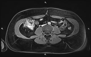 File:Bilateral adrenal myelolipoma (Radiopaedia 63058-71537 H 70).jpg
